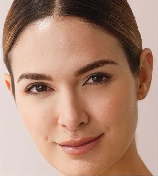 Female patient after Full Face harmonization with dermal fillers at Lumiee Clinic in Cartagena – natural facial contouring and anti-aging results.