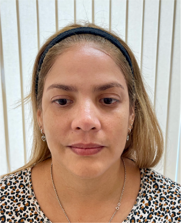 Before photo of international patient at Lumiée Clinic prior to Full Face rejuvenation – starting point for non-invasive facial transformation in Colombia.