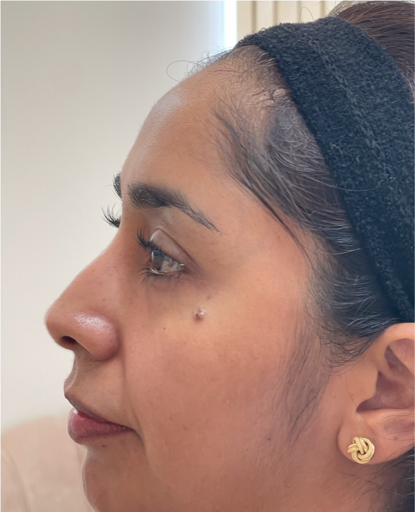 Before photo of a patient preparing for non-surgical rhinomodeling at Lumiée Clinic – natural profile enhancement procedure.