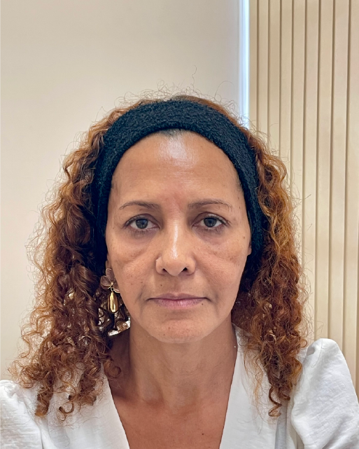 Before photo of international patient at Lumiée Clinic prior to Full Face rejuvenation – starting point for non-invasive facial transformation in Colombia.