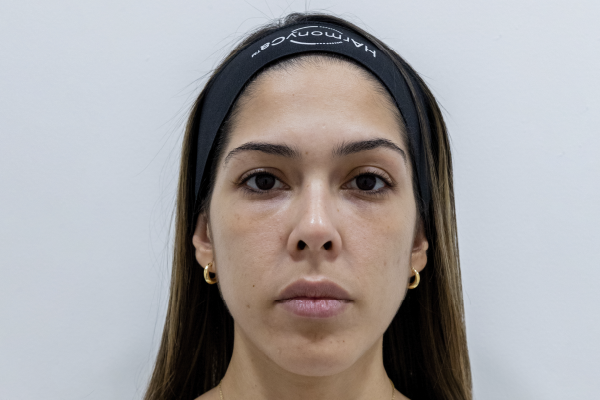 Ojeras y mirada cansada: tratamientos faciales en Cartagena que pueden ayudar