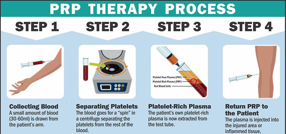 prp therapy raynham
