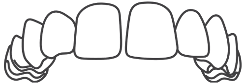 Close Gaps Between Teeth