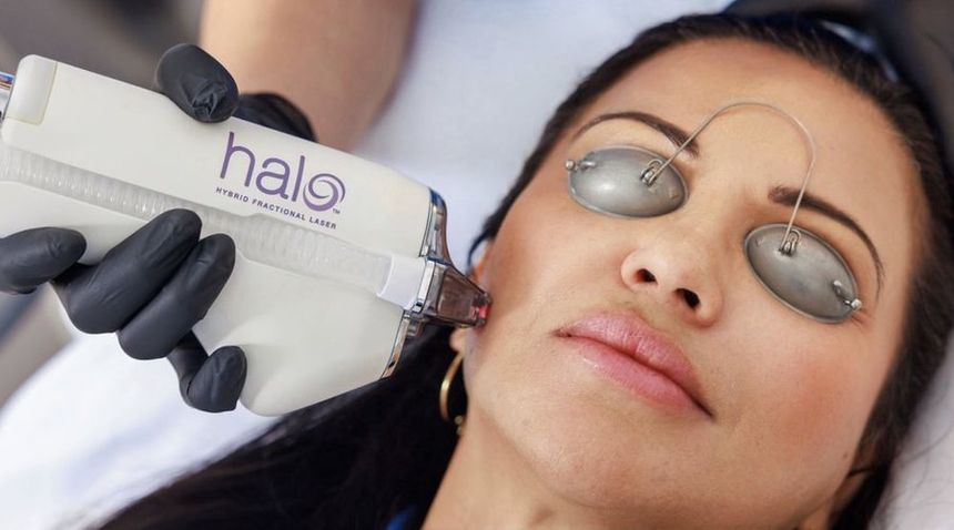 HALO hybrid fractional laser treatment