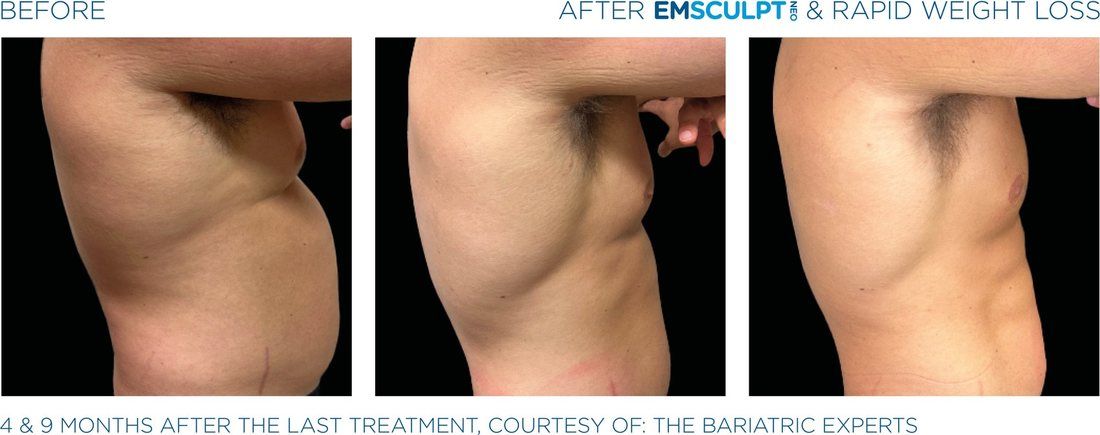 EmSculpt NEO and rapid weight loss, before and after