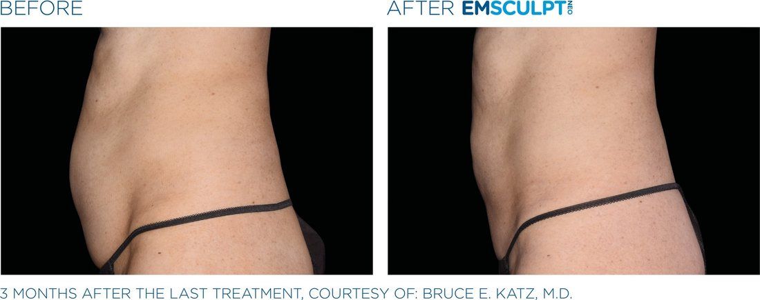 EmSculpt NEO abdomen, before and after