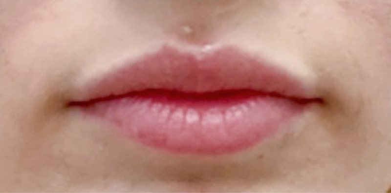 Before: lip enhancement