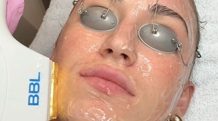 BBL light treatment on the face