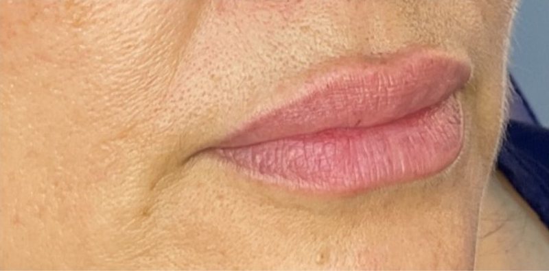 Before: lip enhancement