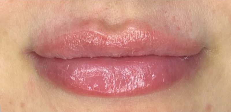 After: lip enhancement