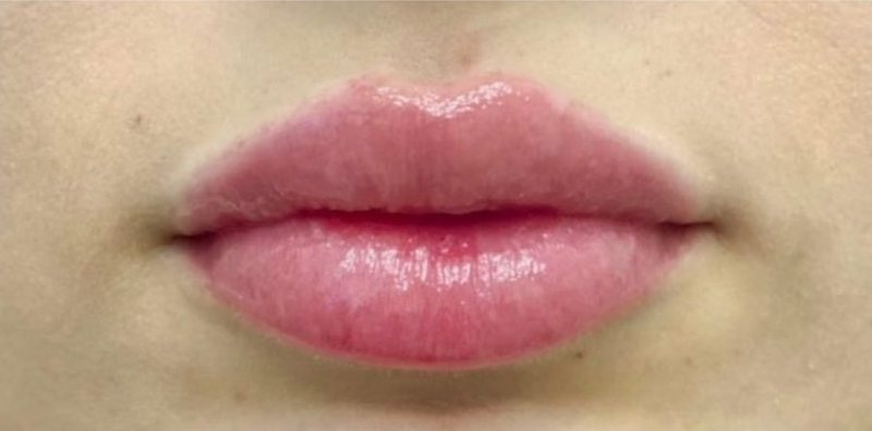 After: lip enhancement