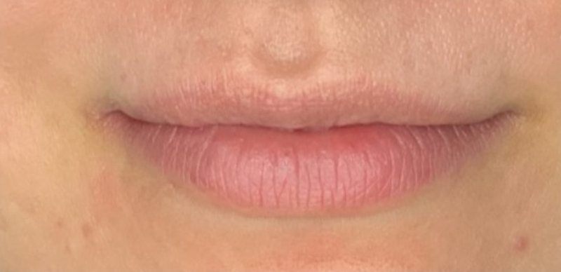 Before: lip enhancement