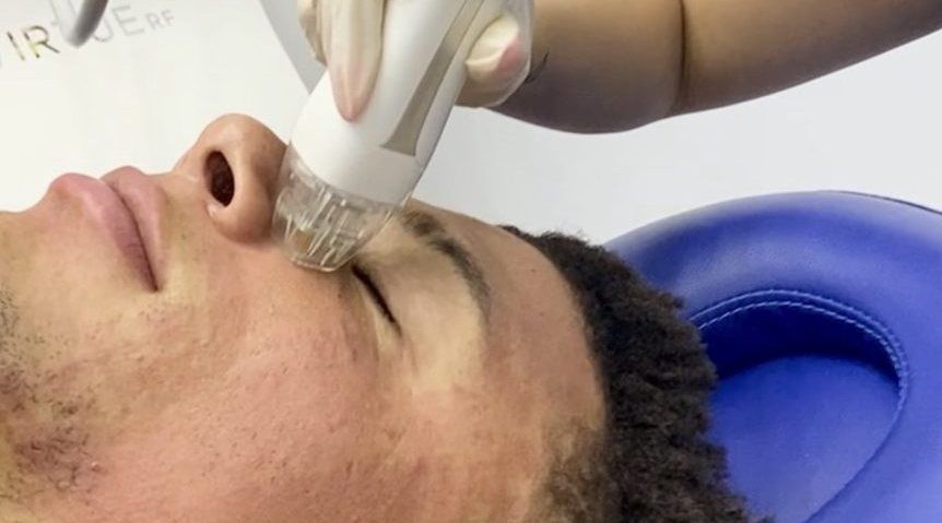 VirtueRF microneedling treatment