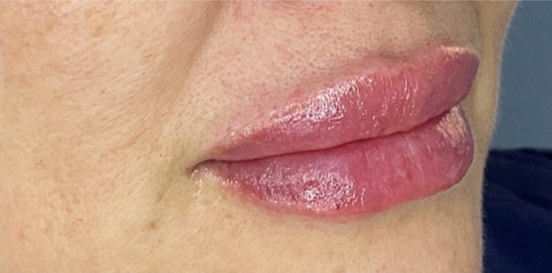 After: lip enhancement