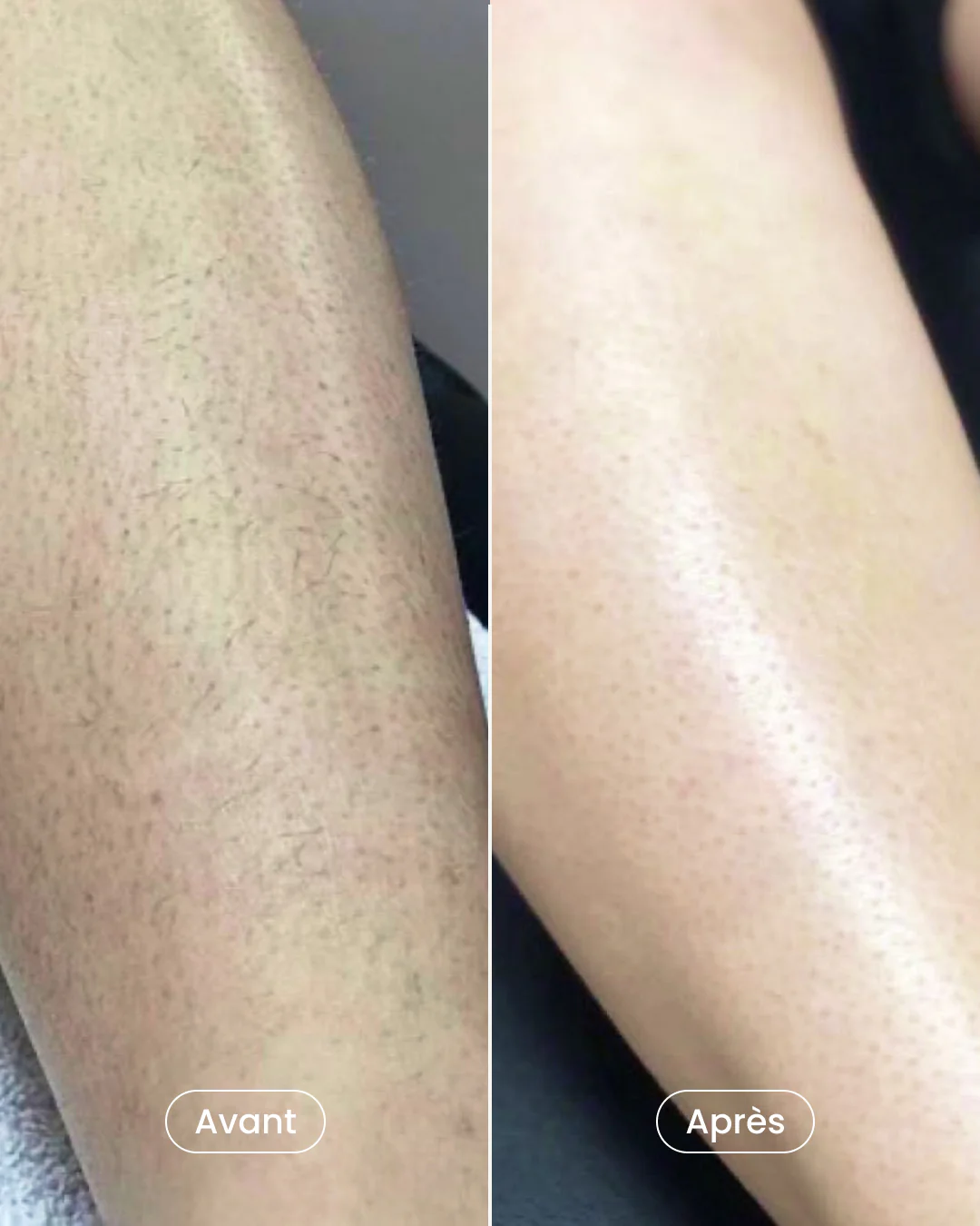 Séance laser sans douleur clinique