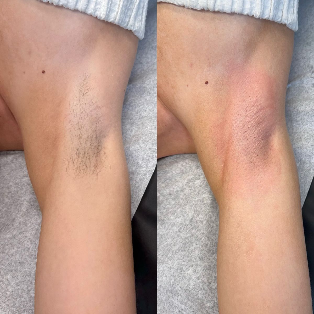 Résultat épilation laser jambes Casablanca