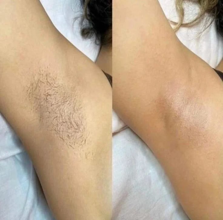 Patiente satisfaite épilation définitive