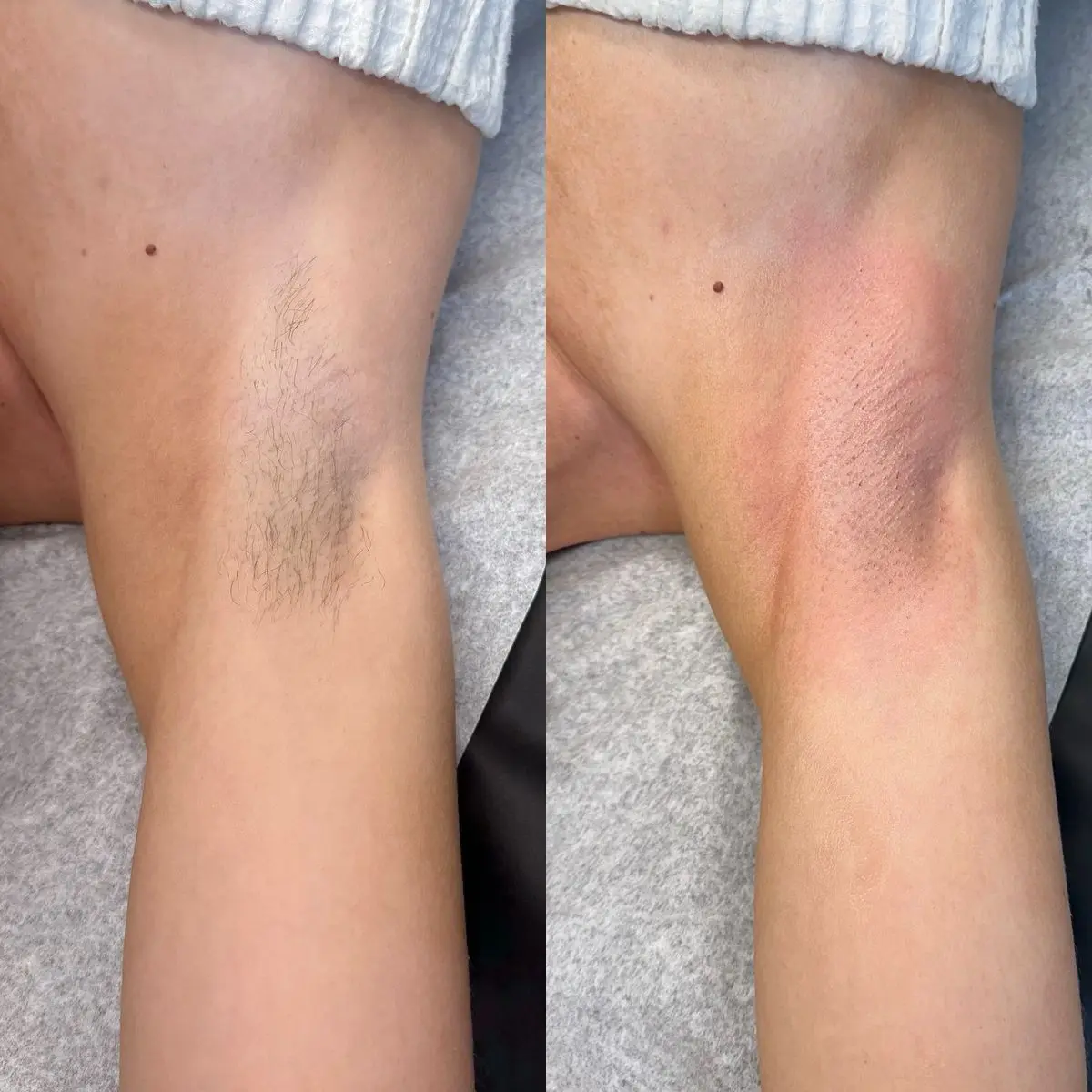 Résultat épilation laser jambes Casablanca