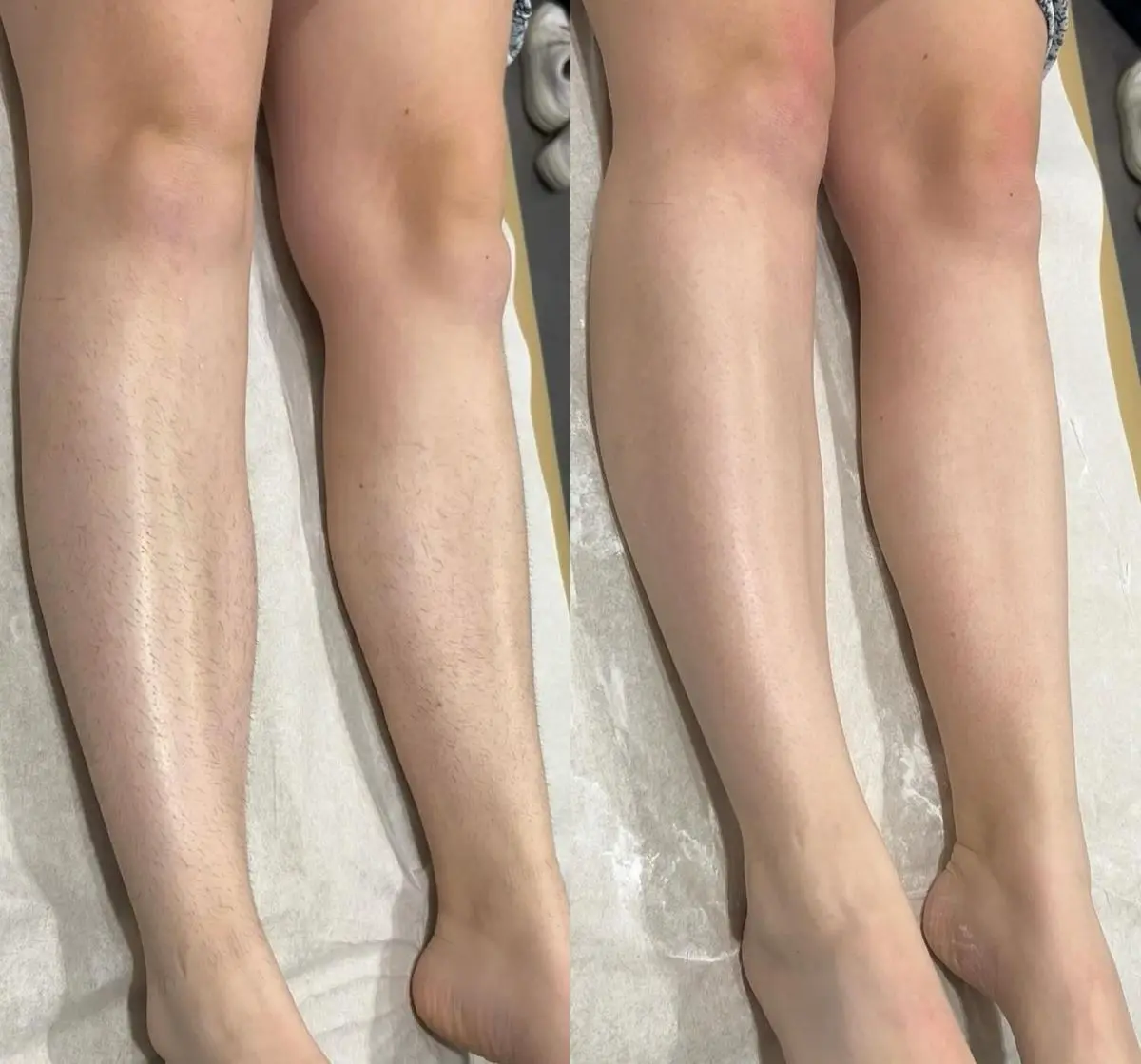 Séance laser sans douleur clinique