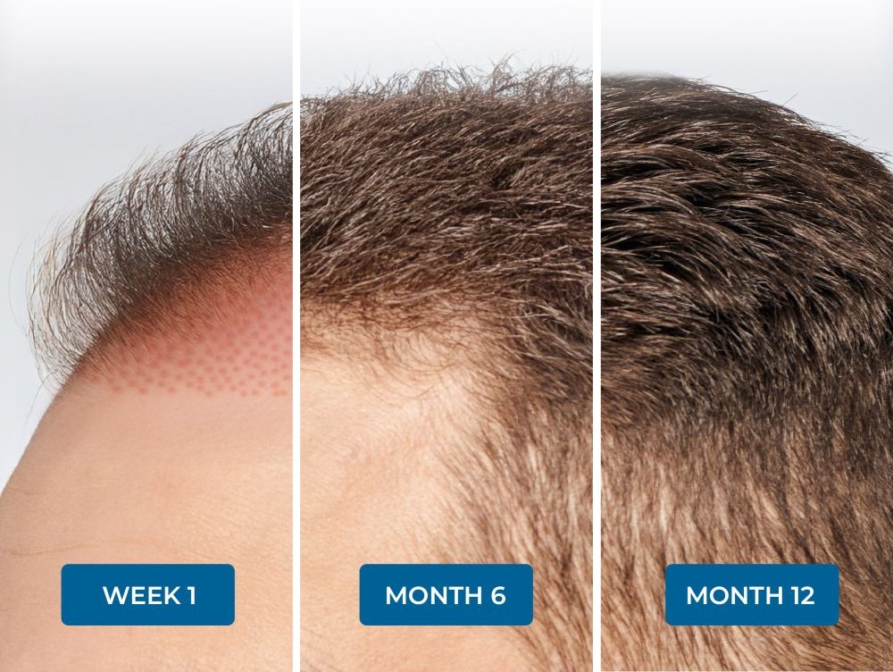 Real hair regrowth results