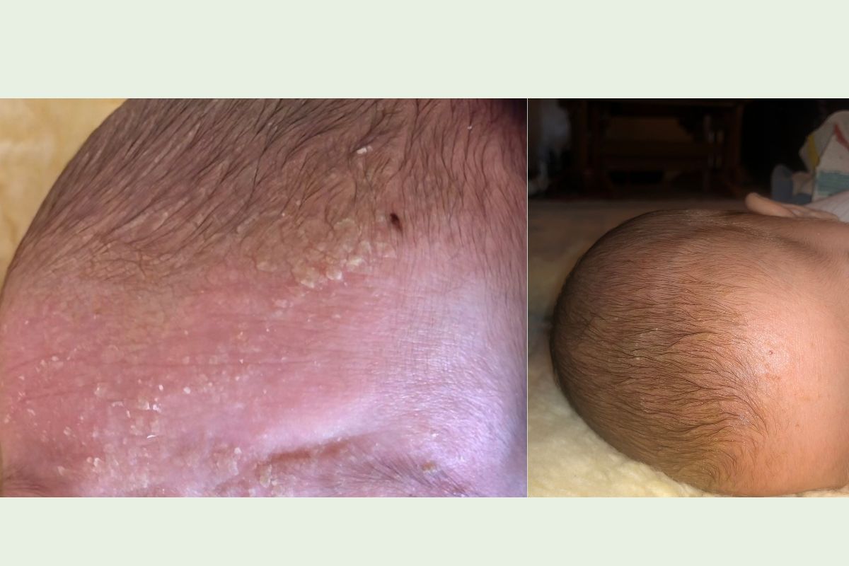 cradle cap on baby scalp before and after using gentle skin salve