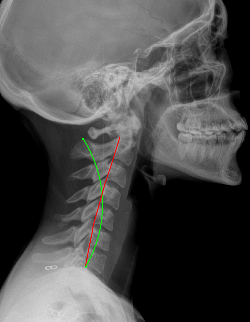 Lateral view X-ray of a human neck and skull, showing cervical vertebrae, jaw, and skull outlines, with green and red lines indicating angles or measurements.