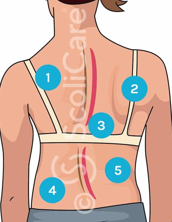 Diagram illustrating the warning signs of scoliosis, provided by ScoliCare, highlighting our commitment to educating the public about early detection and treatment of scoliosis