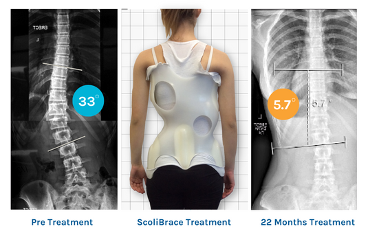 Comparison of spinal X-rays before and after scoliosis treatment with a scoliosis brace, showing significant correction after 22 months.