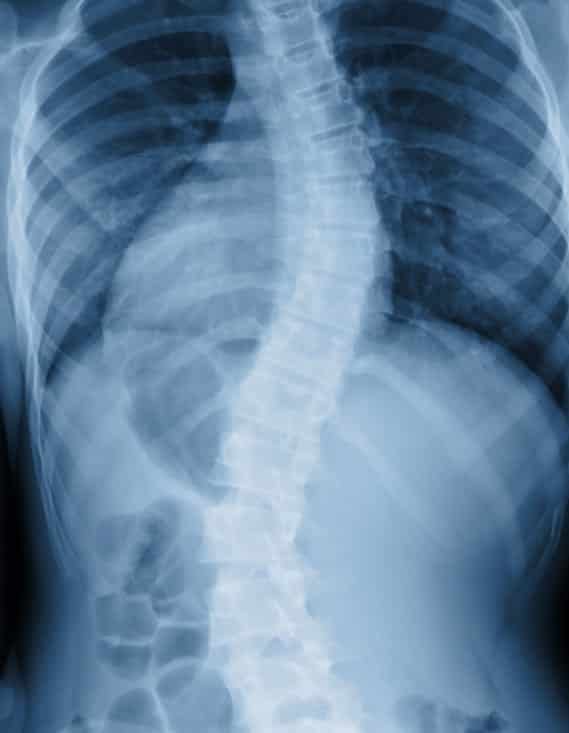 Spinal X-ray showing disc and vertebrae structure at Lake Nona Chiropractic
