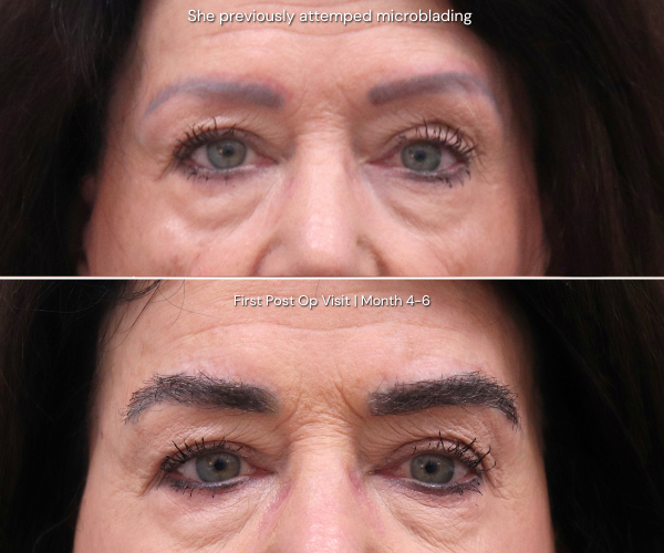 Eyebrow transplant before and after result - patient 3