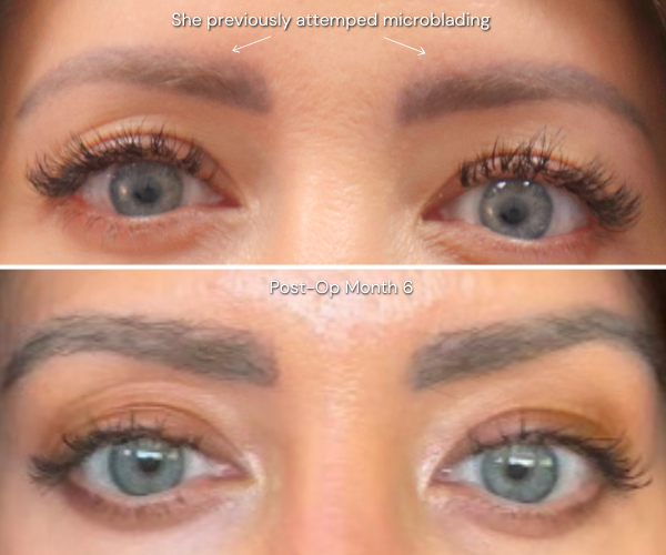Eyebrow transplant before and after result - patient 2