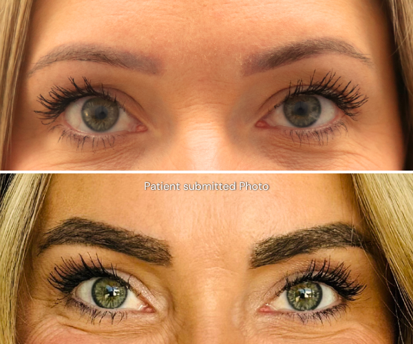 Eyebrow transplant before and after result - patient 1