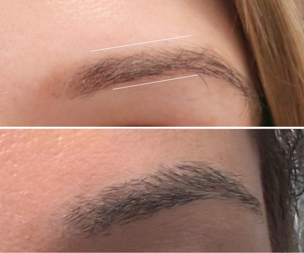 Eyebrow transplant before and after — widening and density improvement