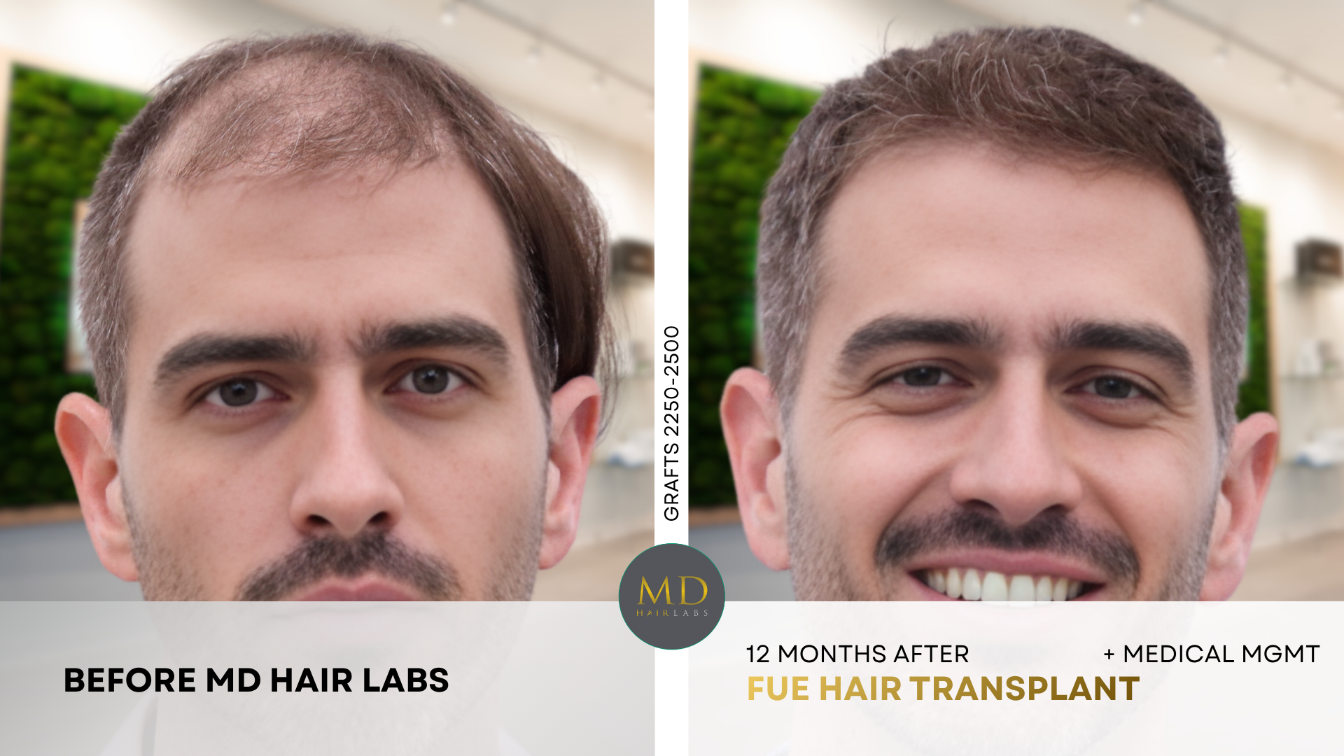 Hair transplant before and after — full restoration