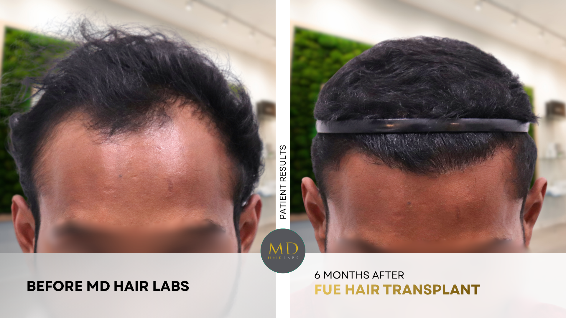 Hair transplant before and after — natural hairline restoration