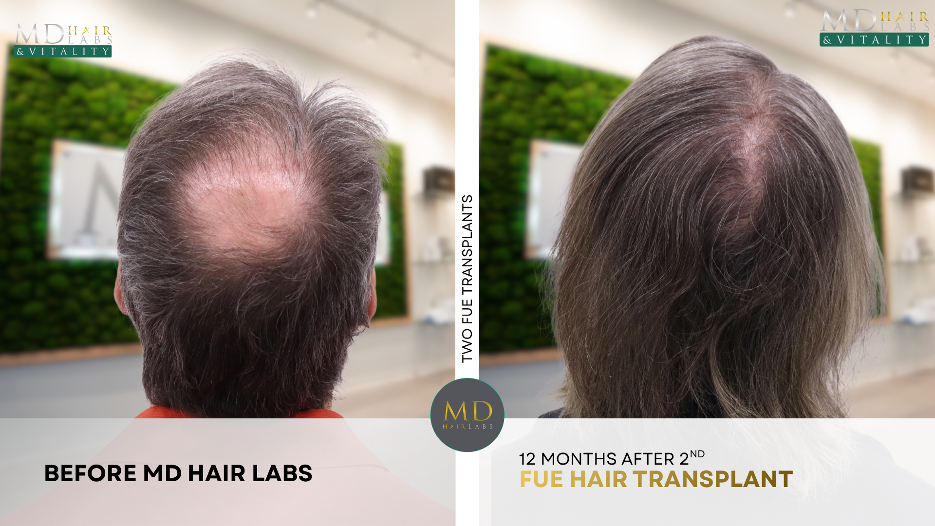 Hair transplant before and after — large crown restoration
