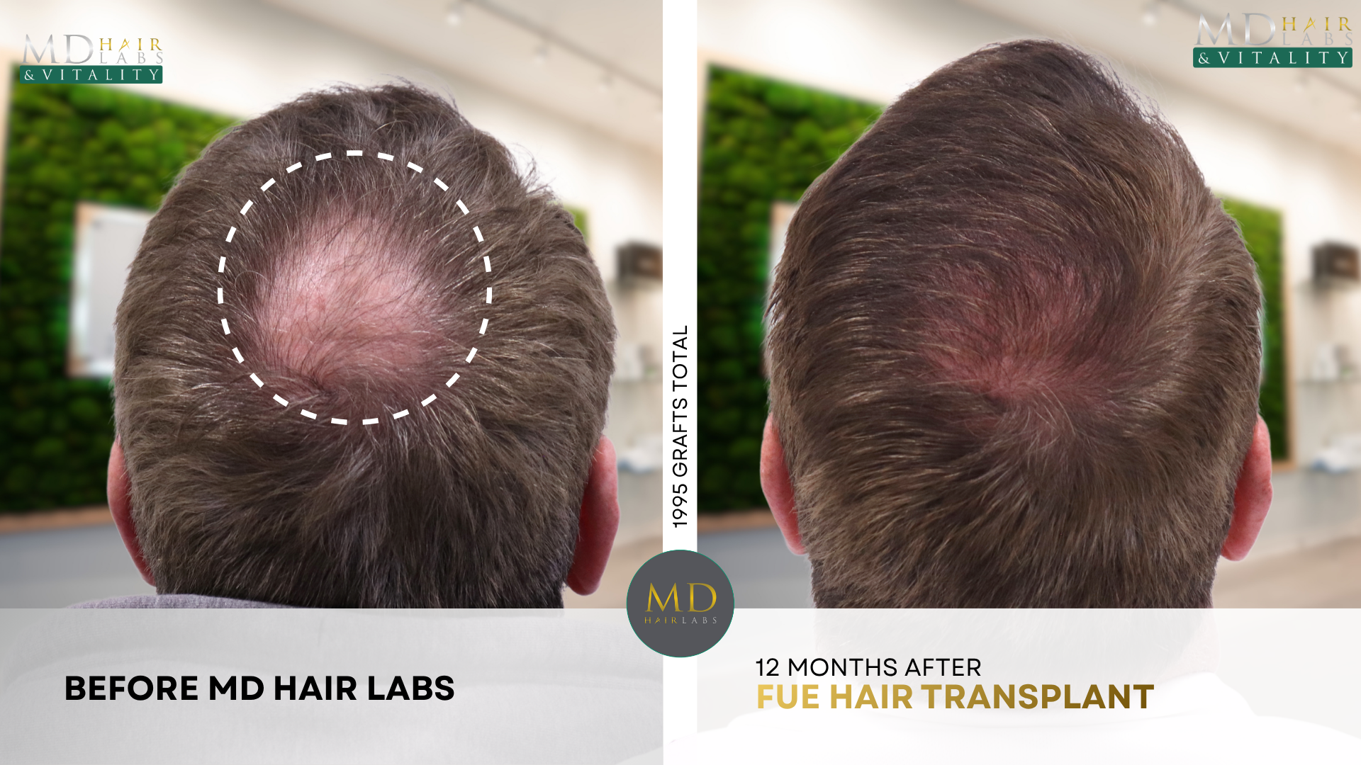 Hair transplant before and after — crown restoration 1995 grafts