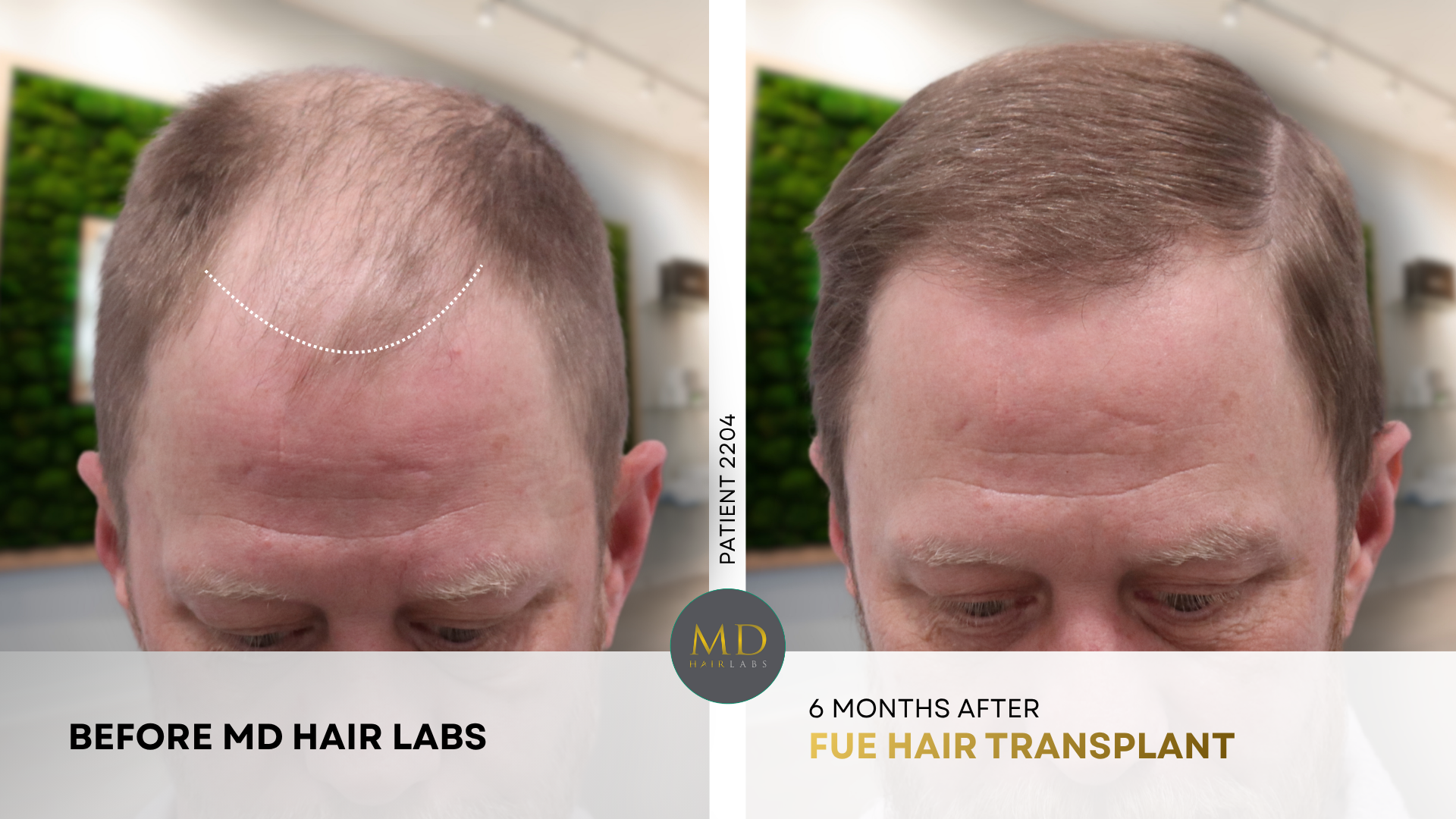 Hair transplant before and after — hairline and mid-scalp restoration
