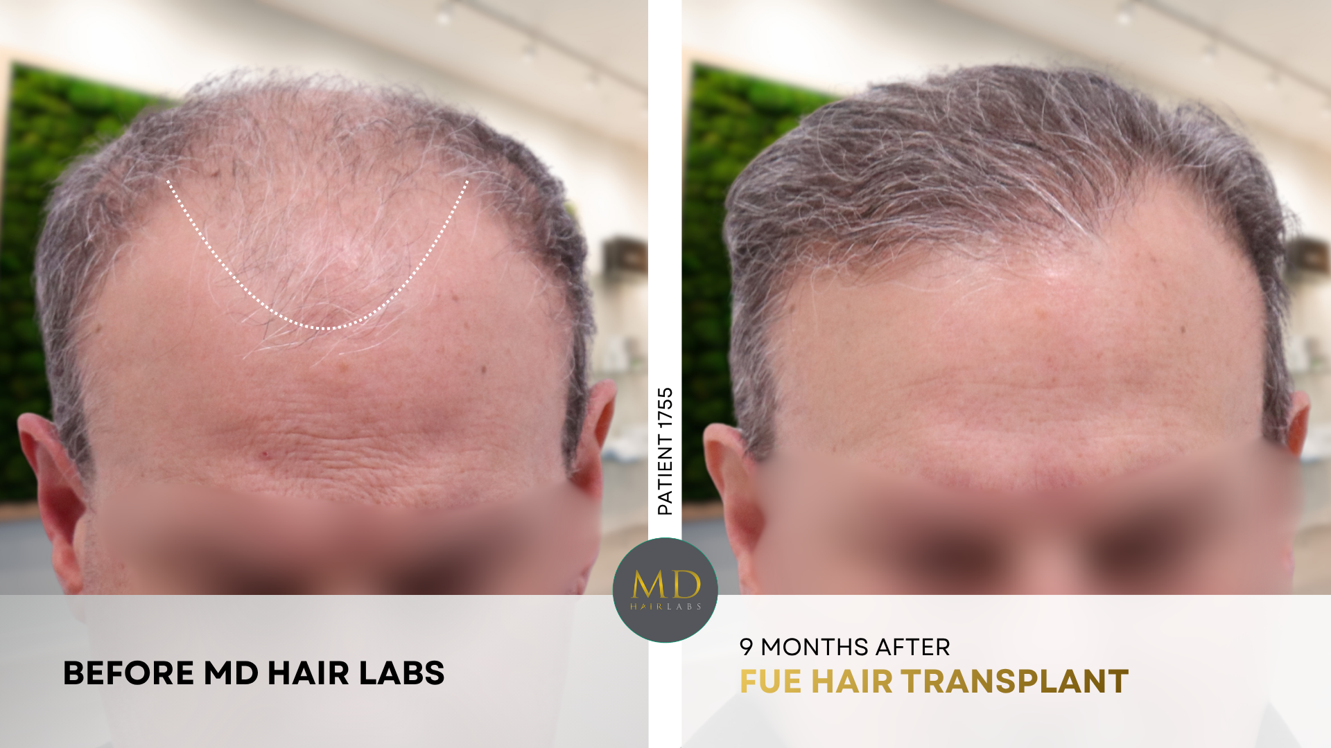 Hair transplant before and after — hairline and mid-scalp restoration