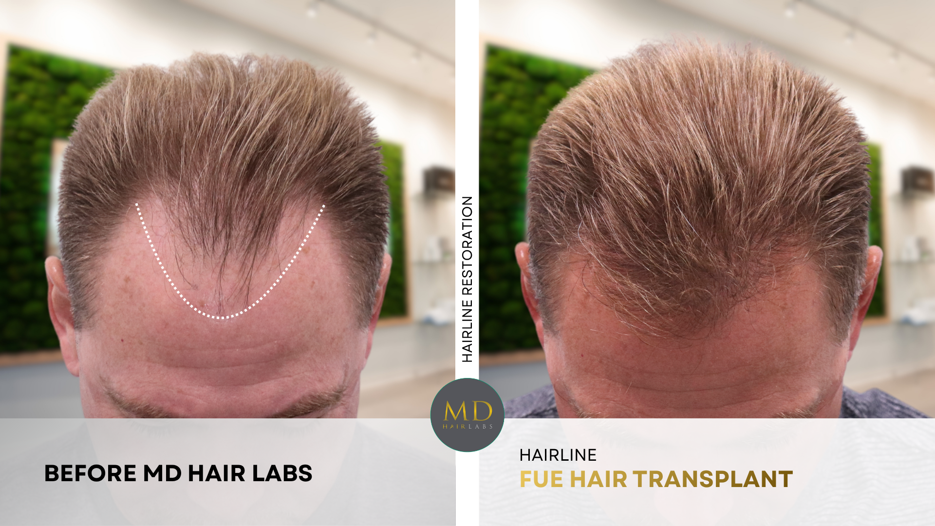 Hair transplant before and after — natural hairline restoration