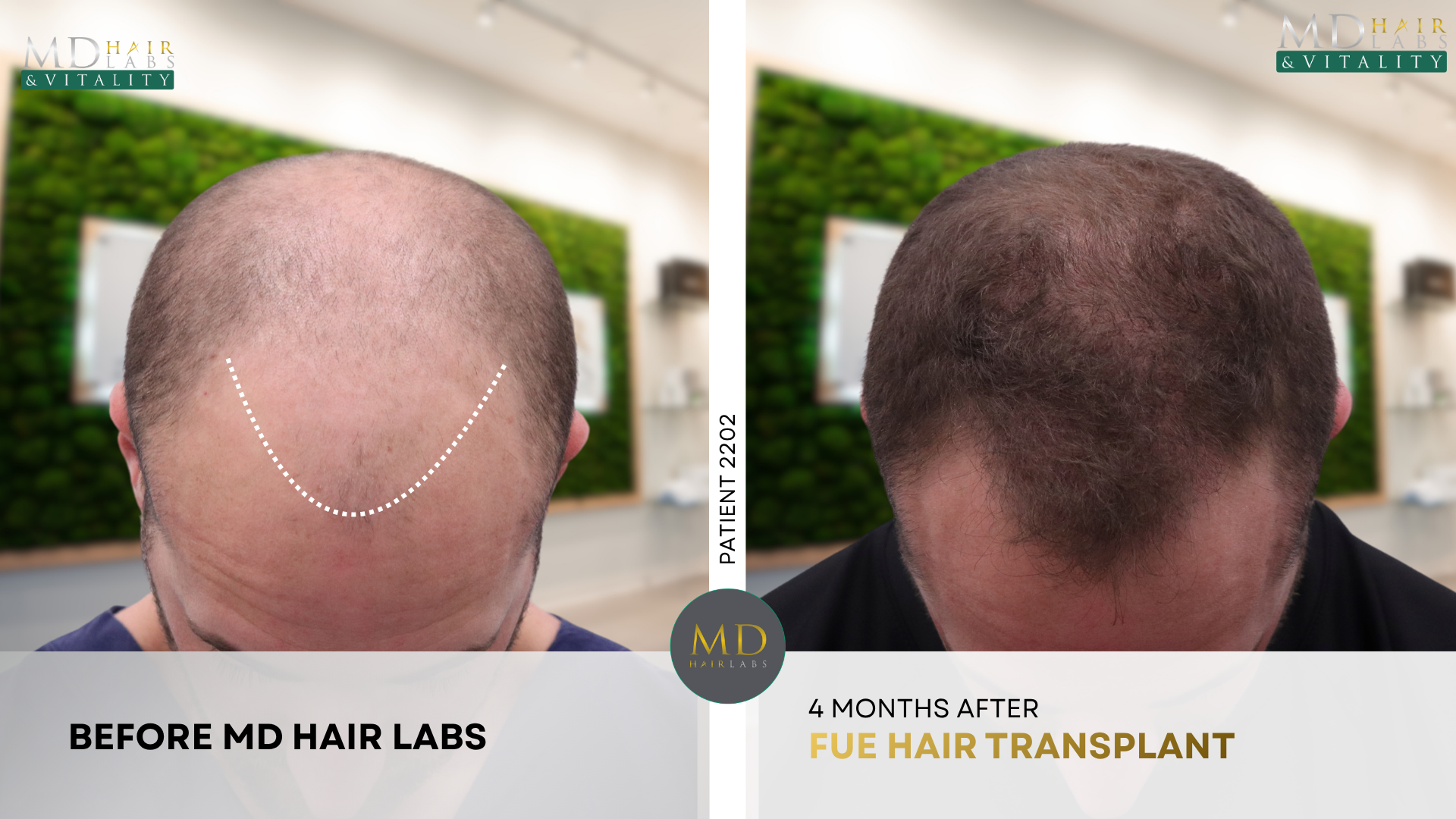 Hair transplant before and after — hairline and mid scalp restoration
