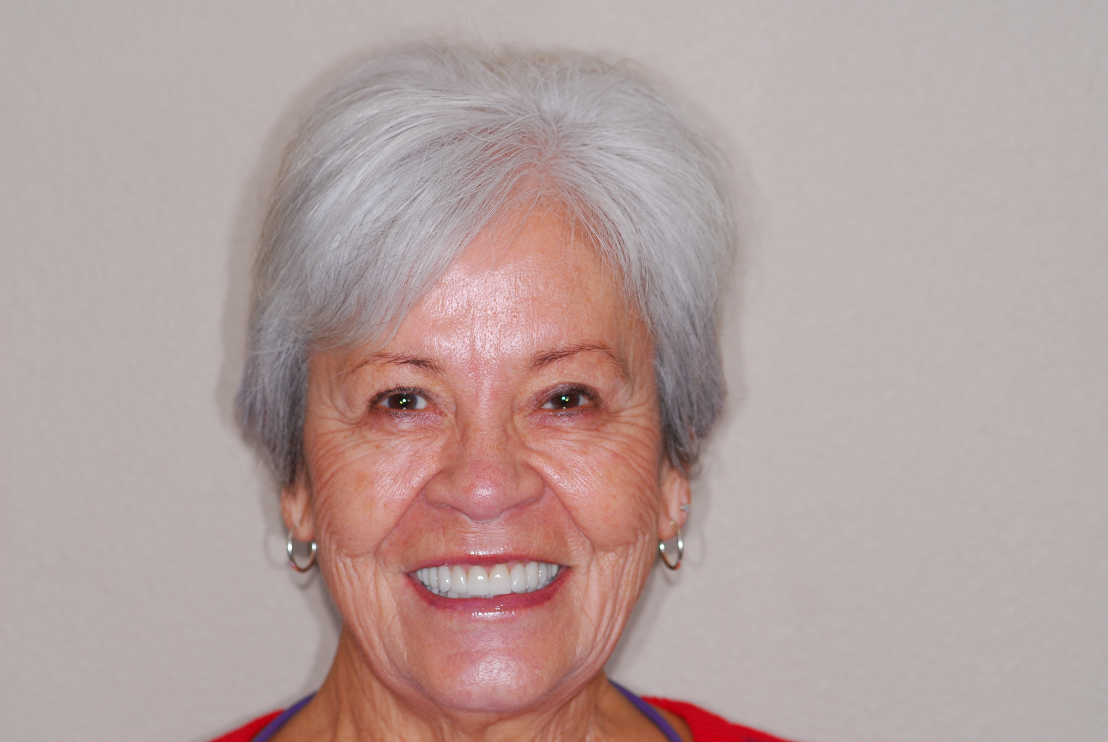 Patient smile after dental implant treatment