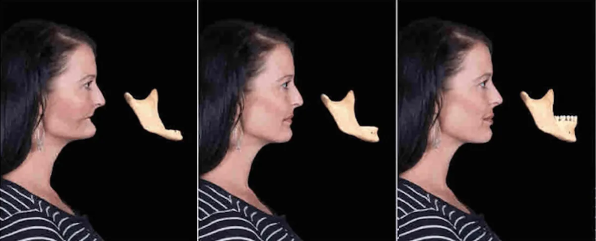 Images of what bone loss looks like after missing teeth