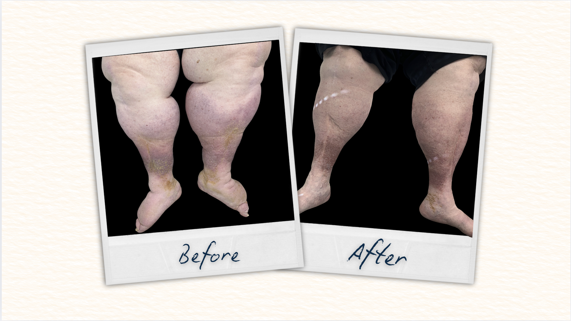 Before and after comparison of a StopMySwelling patient