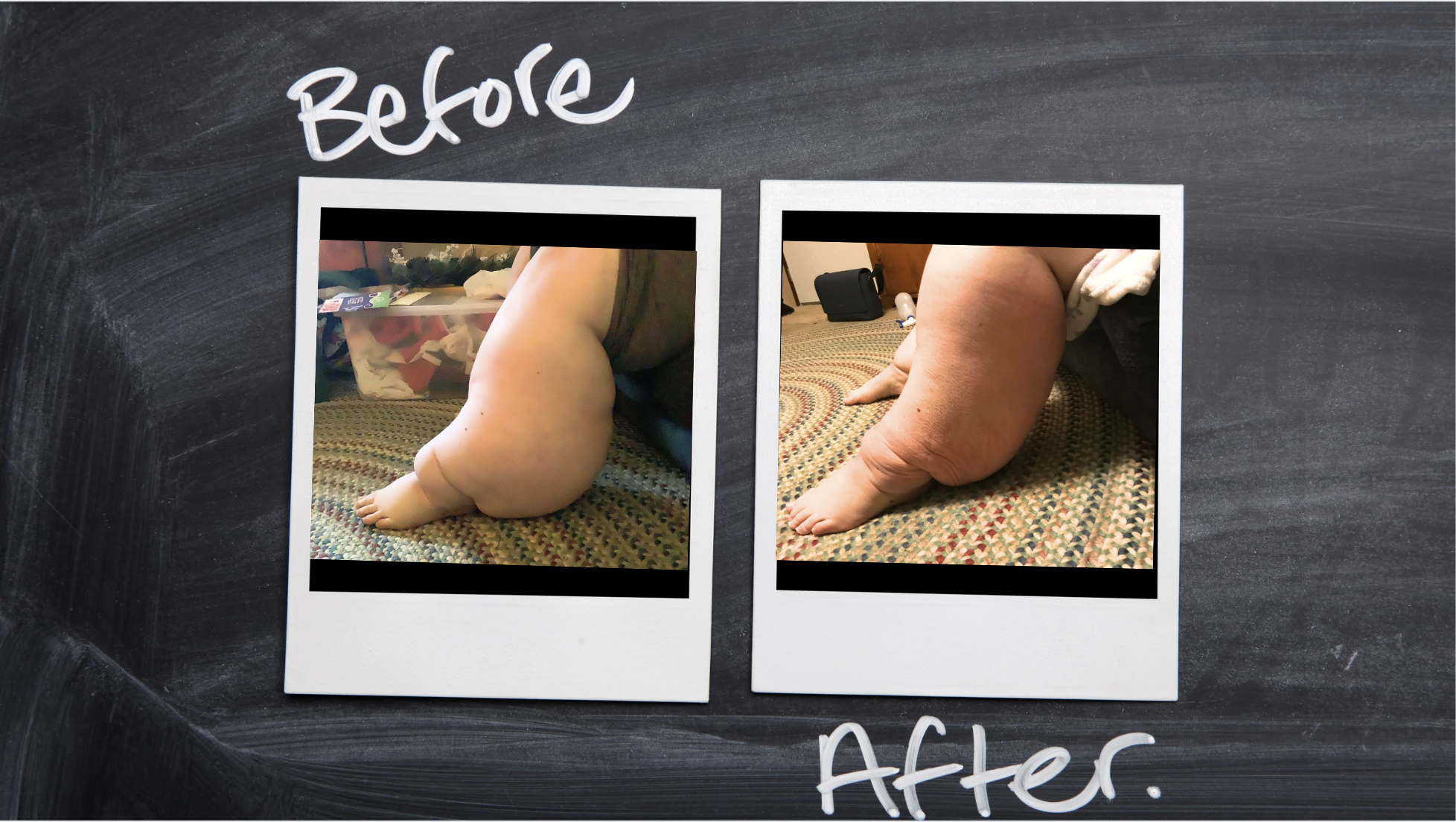 Before and after comparison of a StopMySwelling patient