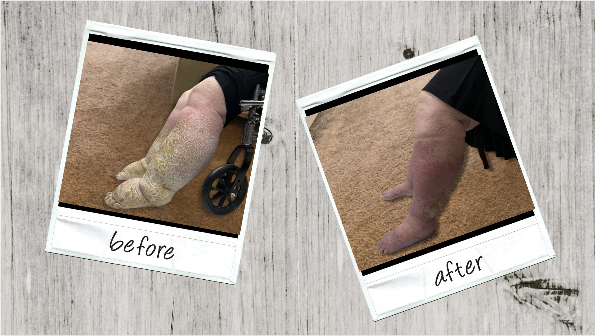 Before and after comparison of a StopMySwelling patient