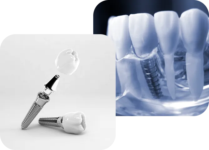 Cross-section illustration of a dental implant showing the titanium screw post anchored in the jawbone with a porcelain crown on top, surrounded by natural teeth and gum tissue
