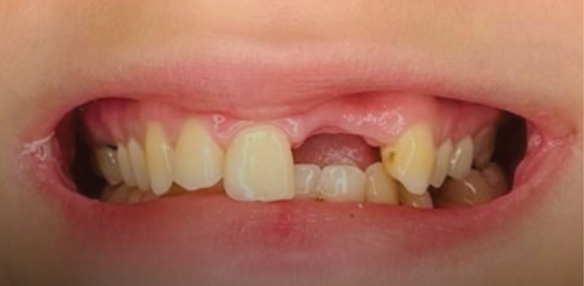 Before