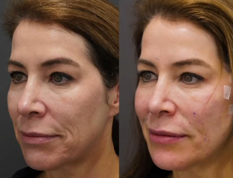 PDO thread lift consultation at LeVogue Med Spa Temecula