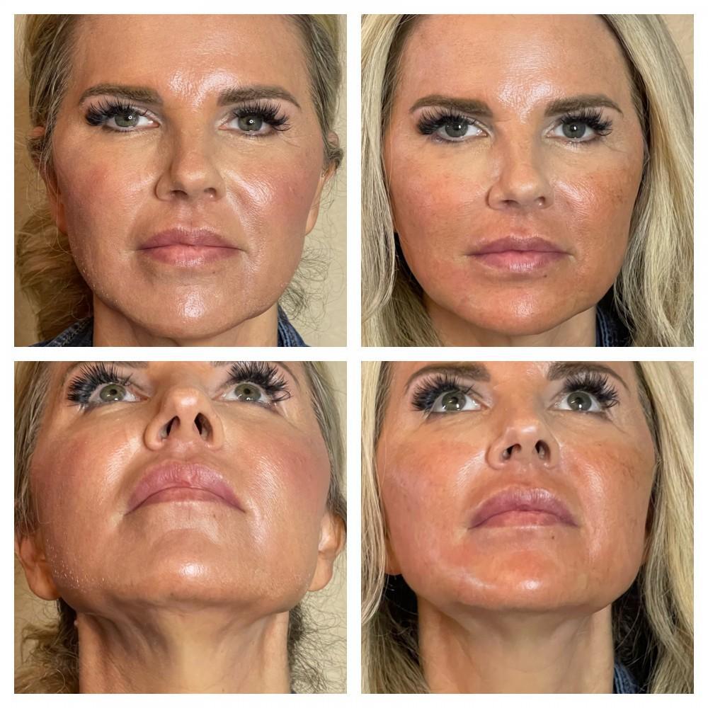 PDO thread lift treatment at LeVogue Med Spa Temecula
